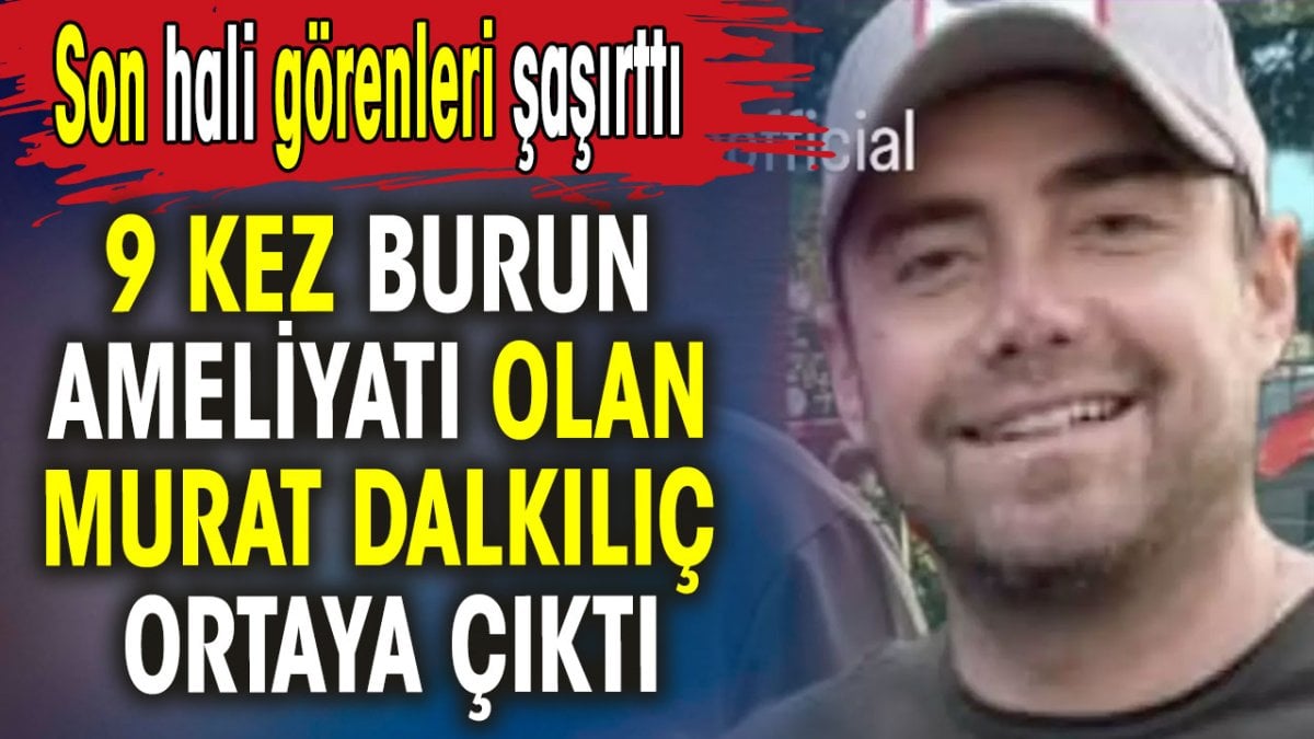9 kez burun ameliyatı olan Murat Dalkılıç ortaya çıktı. Son hali görenleri şaşırttı